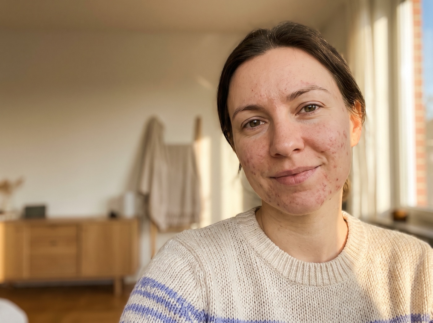 Portrait d'une femme adulte à la peau réelle, concernée par l'acné adulte, au regard apaisé.