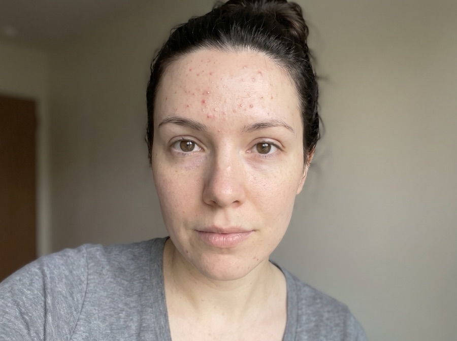 Acné adulte sur le front